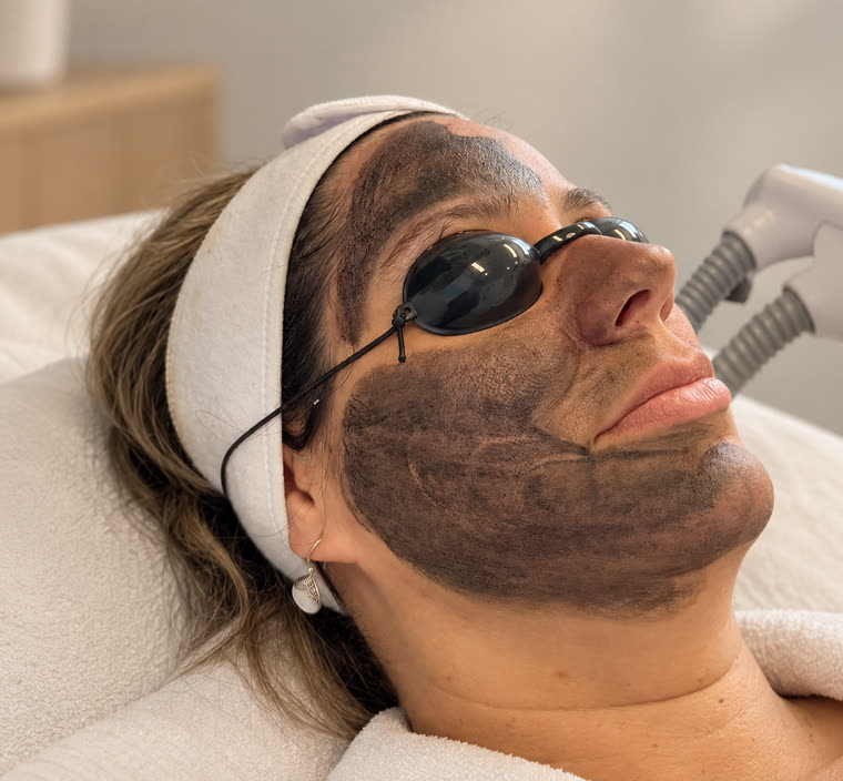 Aufgetragene Kohlemaske im Gesicht vor dem Hollywood Peeling