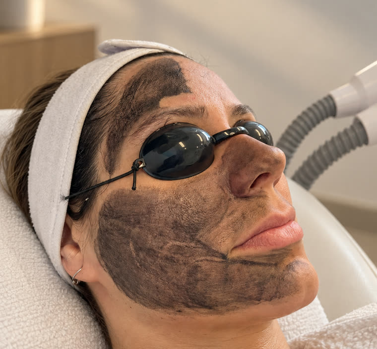 Hollywood Peeling Behandlung im Muse Body Shape Institute in Wohlen